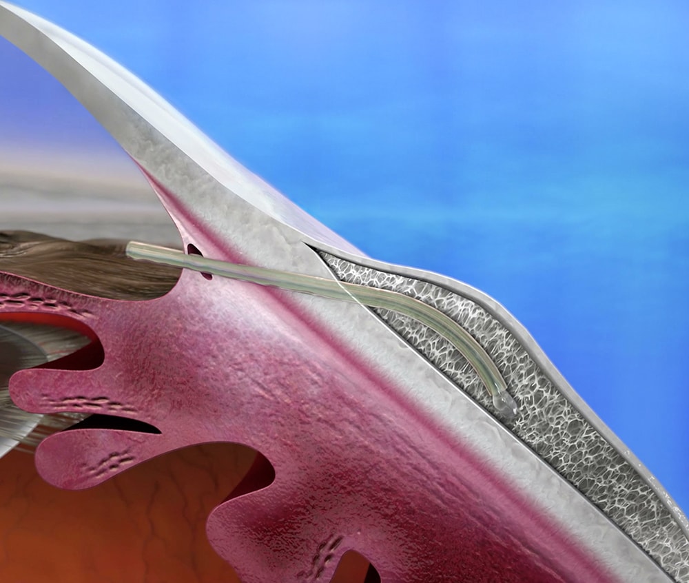 Glaucome - Pose d'un stent
