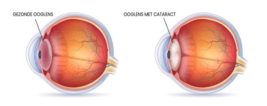 Ooglens met cataract