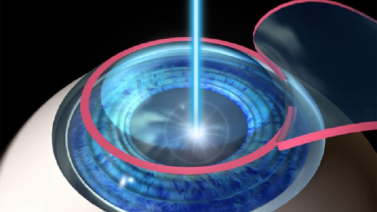 Lasik - chirurgie réfractive par laser