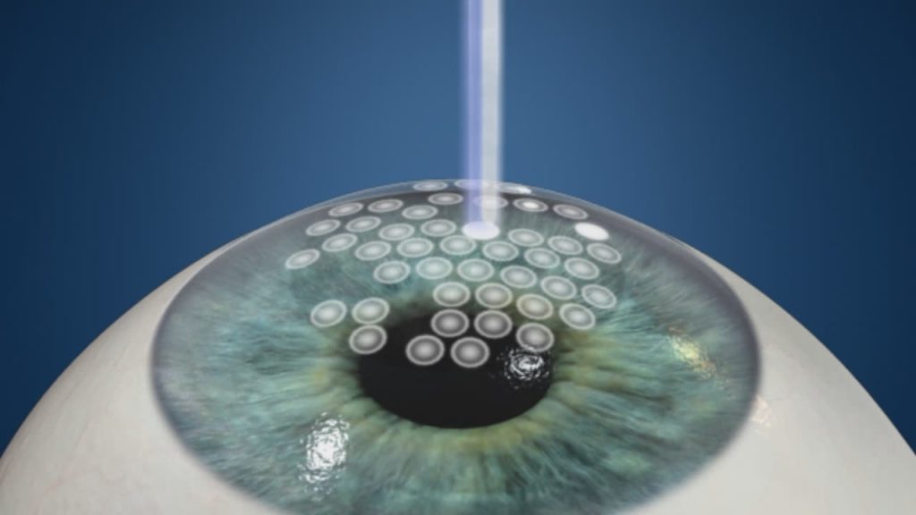 Chirurgies au laser prk lasik dr mathys chirurgien oculaire