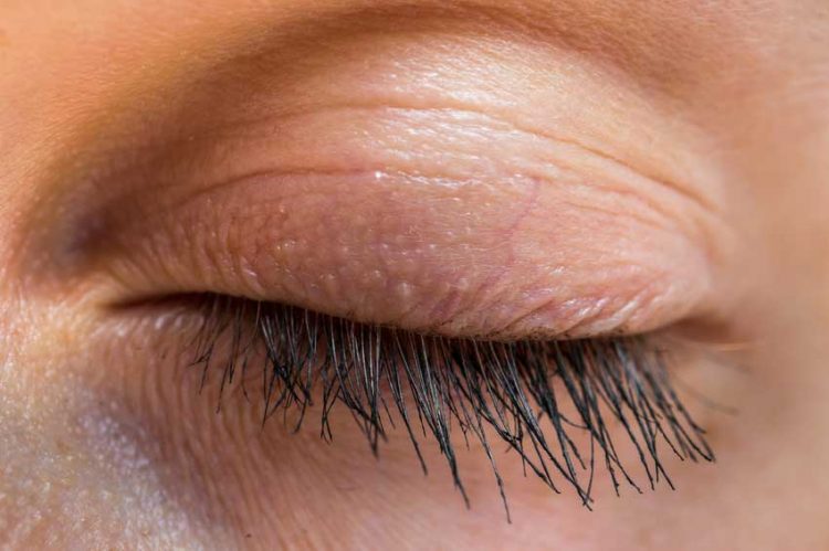 Chirurgie malformation des paupières