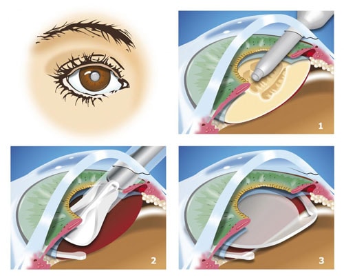 Cataractchirurgie